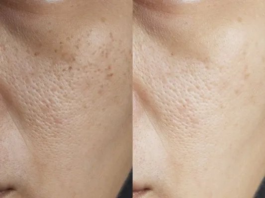 什么方法快速美白