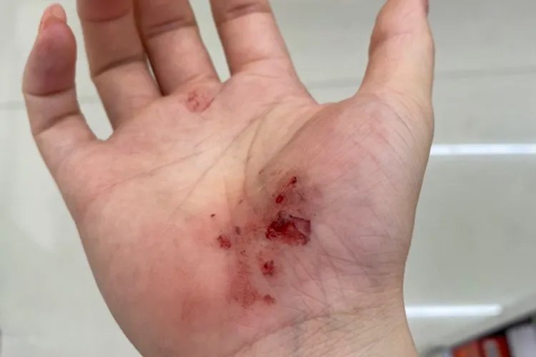 女生手掌擦破皮图片