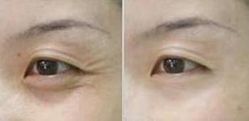 去鱼尾纹一般价格