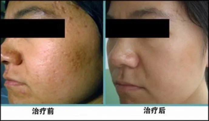 像素激光治疗痘疤