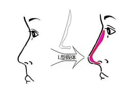 假体隆鼻失败修复费用