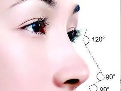 鼻梁打玻尿酸好吗