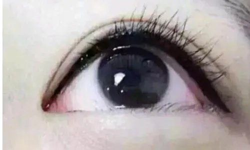 全切双眼皮的效果好不好