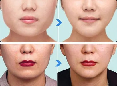 面部光纤溶脂多少钱