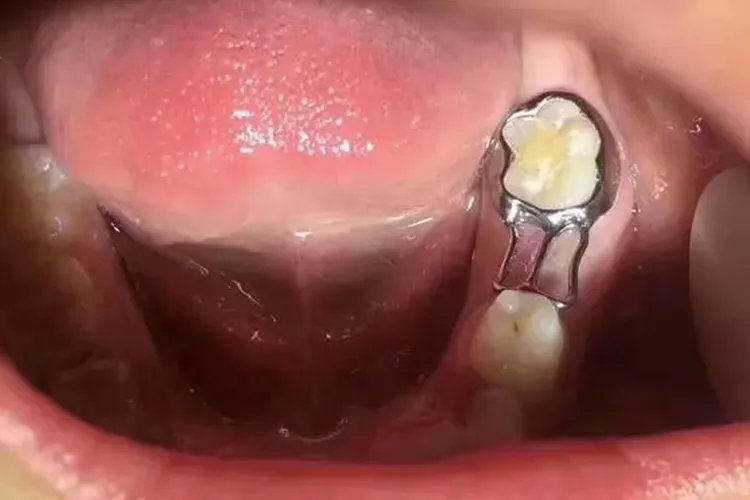 乳牙间隙保持器图片