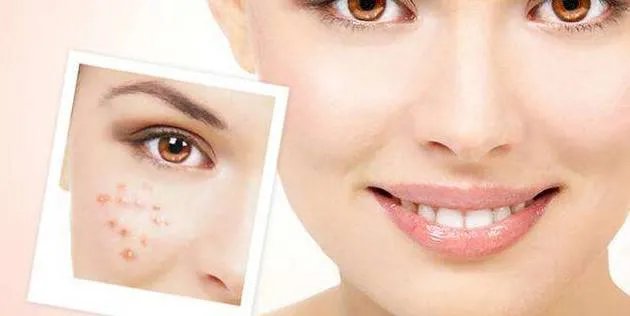 复合彩光祛痘印手术需要多少钱