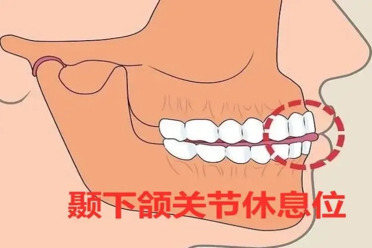 颞下颌休息位示意图