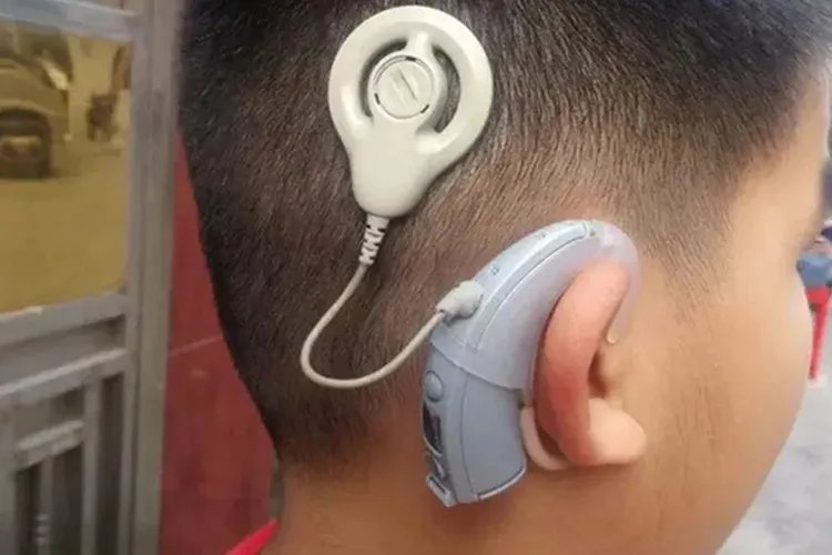 儿童人工耳蜗图片