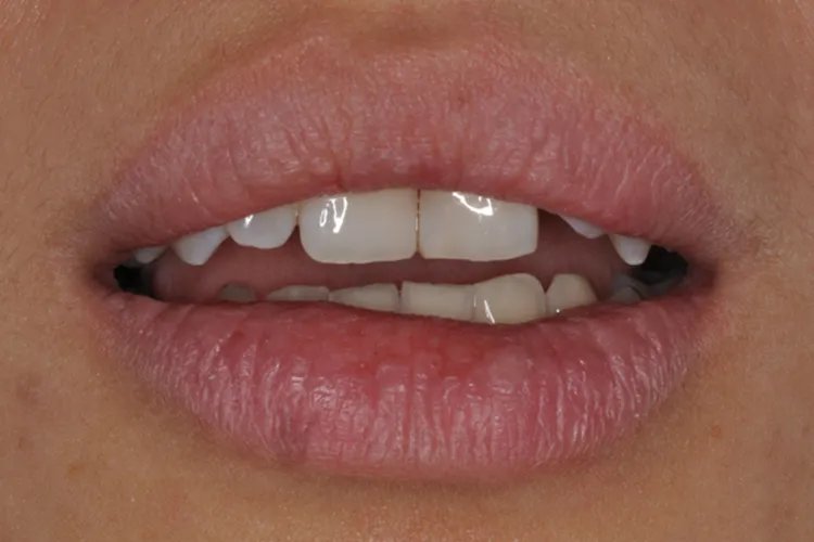 颞下颌休息位示意图