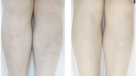 女性e光脱毛有副作用吗