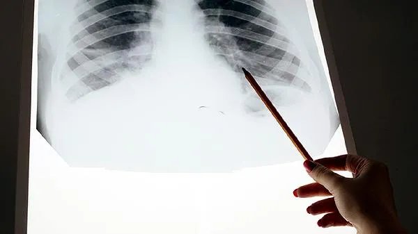 免疫组化检查结果怎么看是肿瘤