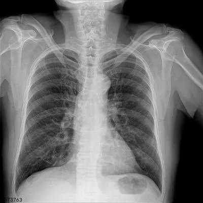 肋骨断了可以自己愈合吗