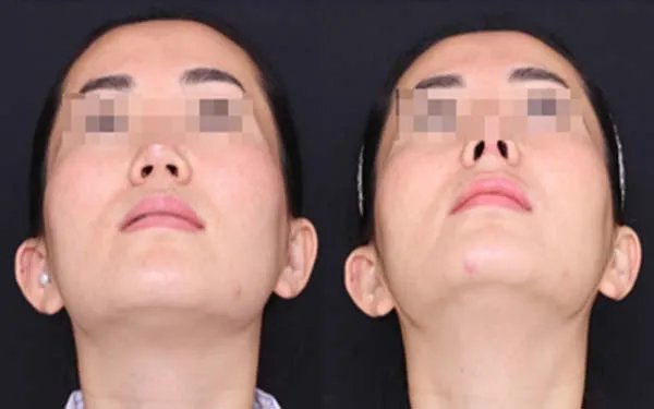 天津医院哪家做玻尿酸隆鼻好