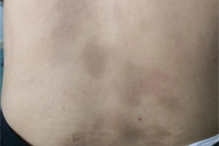 特发性多发性斑状色素沉着症斑图片