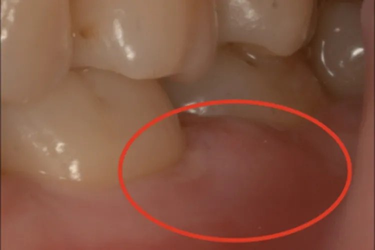 侵袭性牙周炎牙龈脓肿图片
