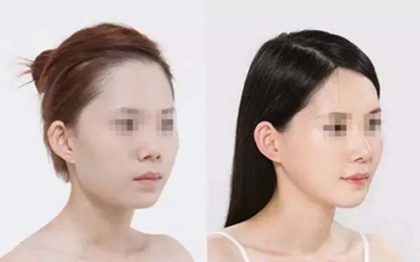 天津医院哪家做玻尿酸隆鼻好