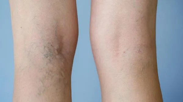 手水肿的原因及处理