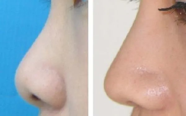 天津医院哪家做玻尿酸隆鼻好