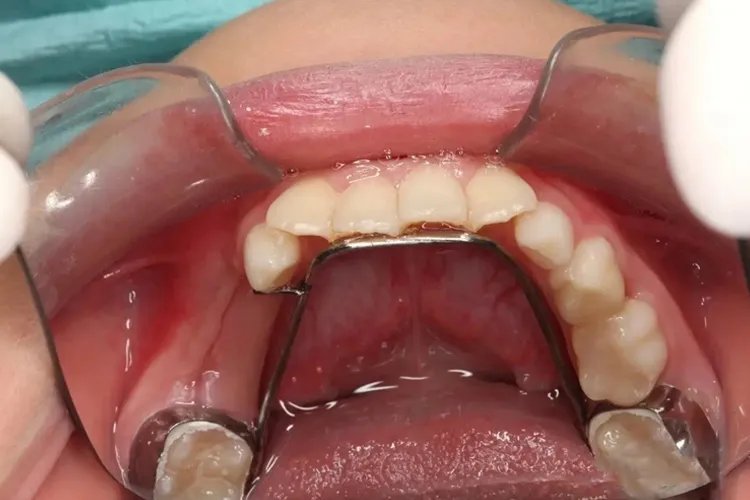 乳牙间隙保持器图片